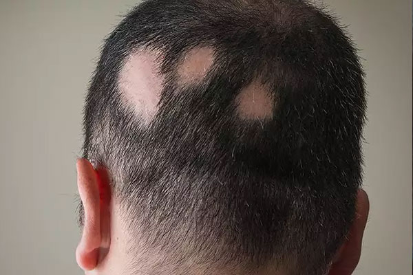 Alopecia Treatment in Jabalpur