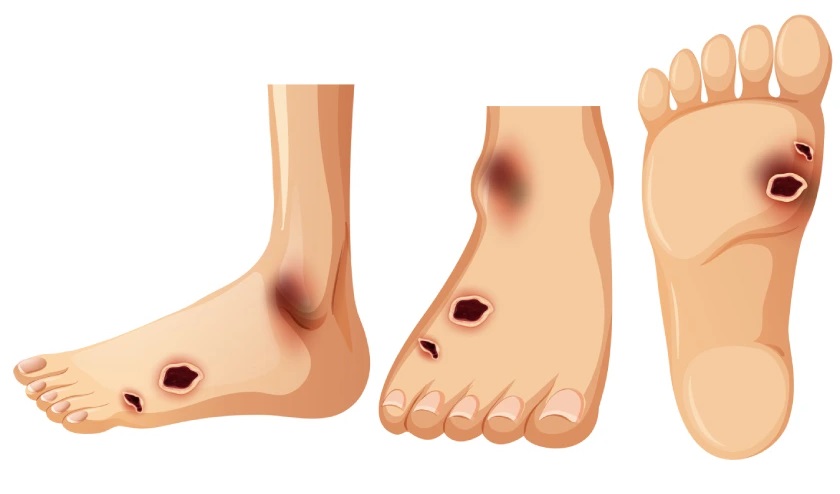 Diabetic Foot Ulcer Treatment in Jaipur