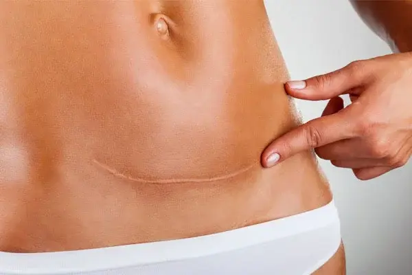 Scar Treatment in Jabalpur
